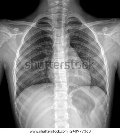 X-Ray Image Of  Chest for a medical diagnosis