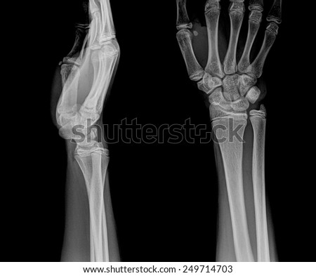 film x-ray wrist show fracture distal radius (forearm\'s bone)