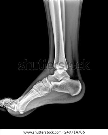 X-rays of leg fracture patients , ankle