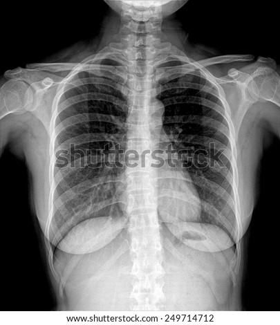 X-Ray Image Of Women Chest