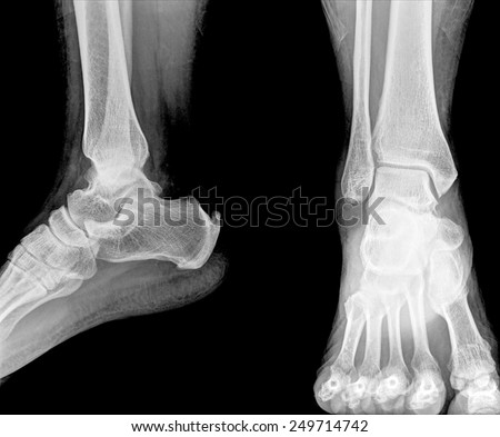 ankle and foot x-rays image