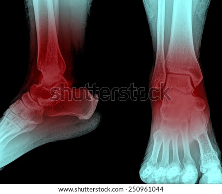 ankle painful  and foot x-rays image