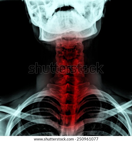 X-ray image of Abnormalities patient neck bone painful  ( cervical vertebra)