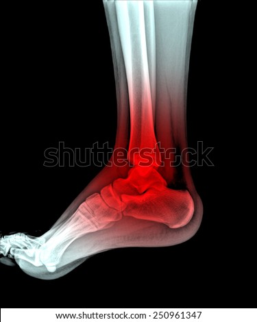 X-rays of leg fracture patients , ankle