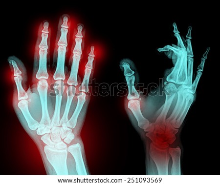 film x-ray both hand AP : show normal patient's hands on black background (isolated)