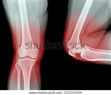 X-ray image Knee joint , red point