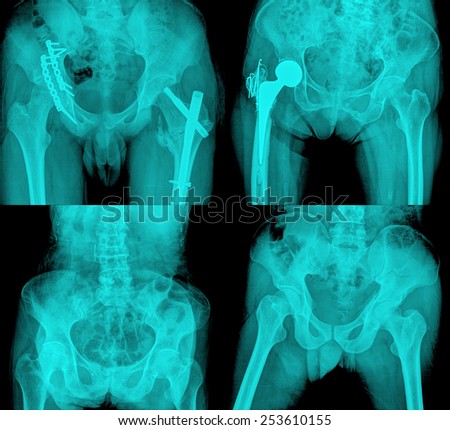 collection of  hip replacement surgery, good outcome