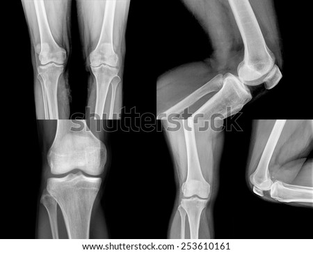 collection of  xray of normal a human knee isolated