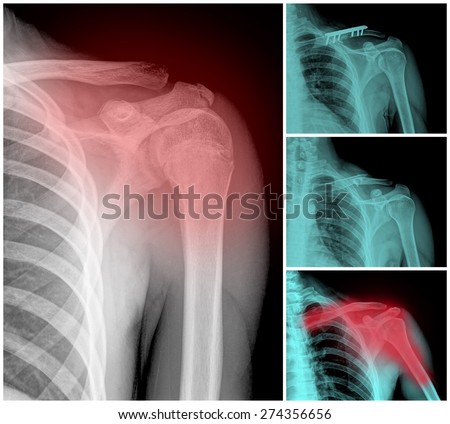 Collage of many shoulder fracture X-rays. Very good quality