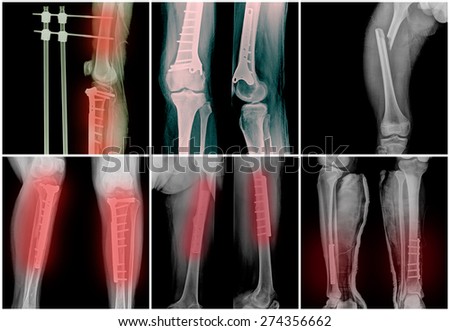 Collage of many bone legs fracture X-rays. Very good quality