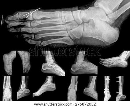 Collage of many foots and ankle painful X-rays. Very good quality