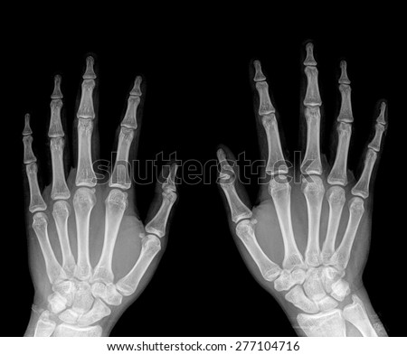 X-Ray Hands ( front view ) : Normal human hands