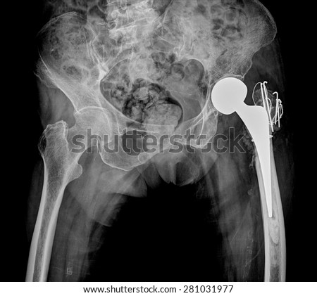 x-ray of hip replacement surgery, good outcome