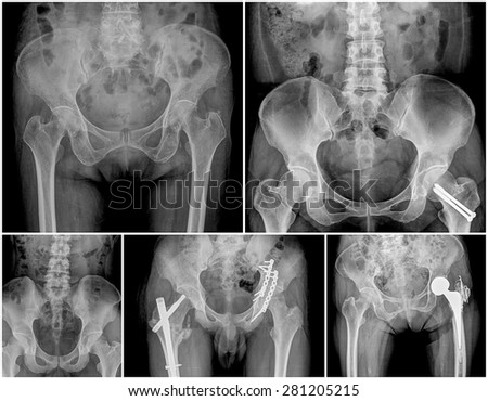 collection of hip replacement surgery, good outcome