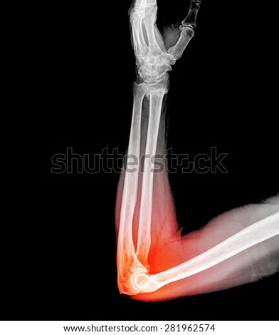 X ray image of broken human elbow