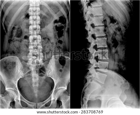 spine and pelvis of a human body on x-ray : show 2 different view