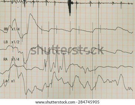 Electrocardiogram graph , ekg heart rhythm, medicine concept