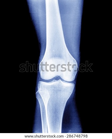 Xray of a human knee joint  isolated
