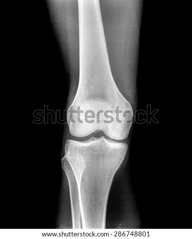 Xray of a human knee joint  isolated