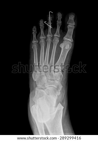 Top view of humans feet bones under x-ray , painful