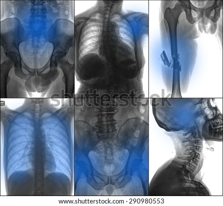 mammography x-ray picture ,isolated on white background