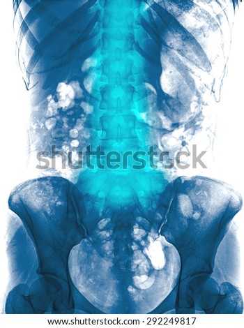 Lumbar spine of woman and inflammation at lumbar spine ( low back pain ) ( X-ray thoracic - lumbar spine