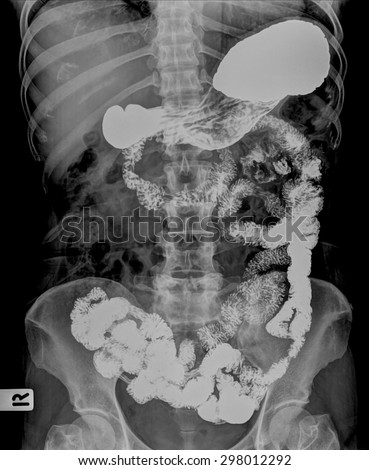 X-ray image of plain abdomen , colon