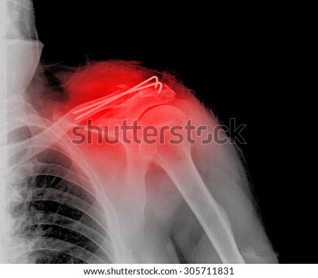 rengs snapshot of the shoulder joint with a bolt , xray