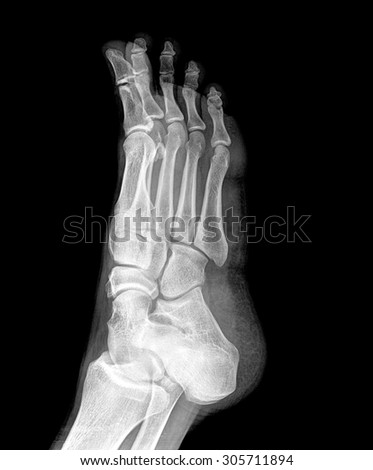 Close up x-ray of foot ankle