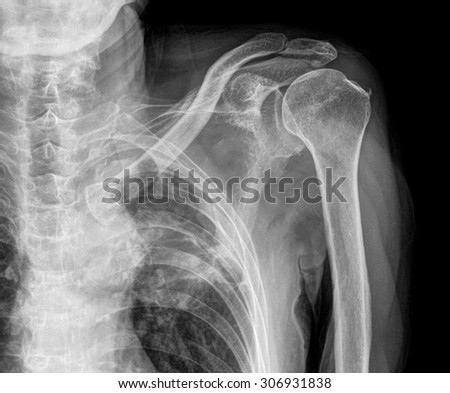 painful shoulder surgery on x-ray