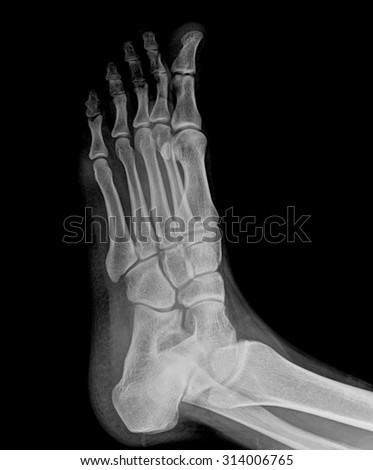 Close-up xray of a human foot isolated on back background , side view