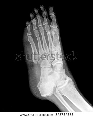 X-ray human\'s ankle with arthritis , side view