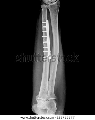 Film x-ray wrist fracture : show fracture radius bone (forearm's bone) with inserted plate and screw
