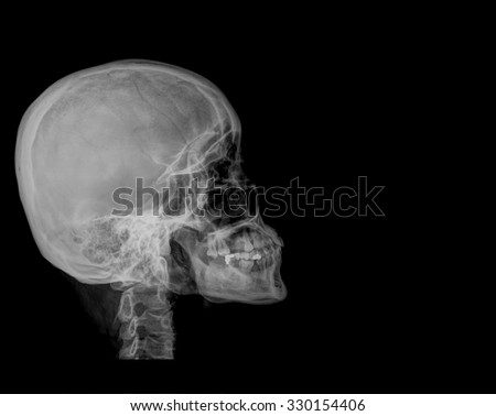 X-ray human piece of skull and spine ( cervical vertebra ) , isolated on black background