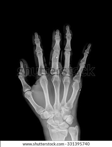 an xray of a hand with broken finger , top view