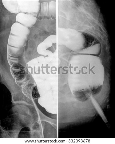 X-ray with opaque contrast medium that shows intestine