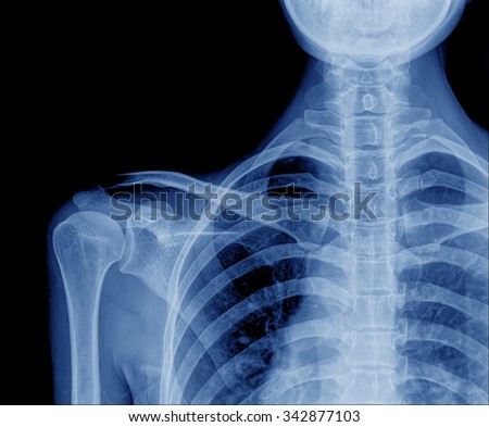 x-rays image of the painful or injury shoulder joint ,shoulder dislocation
