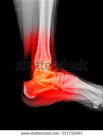 human foot ankle xray picture