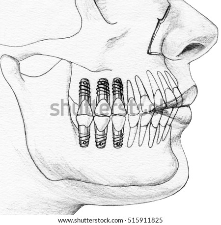 Teeth - Dental Implants In context, cutaway view