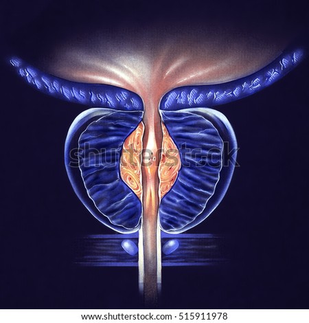 Prostate Gland - (BPH) Benign Prostatic Hyperplasia, Stage 1 - false color to highlight details.