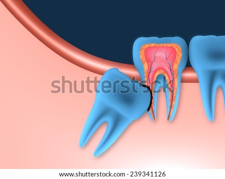 Problems caused by impacted wisdom teeth include.Erosion cavity