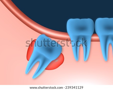 Problems caused by impacted wisdom teeth include.Cysts