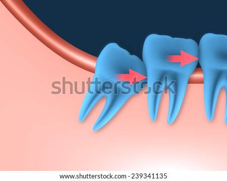 Problems caused by impacted wisdom teeth include.Crowding