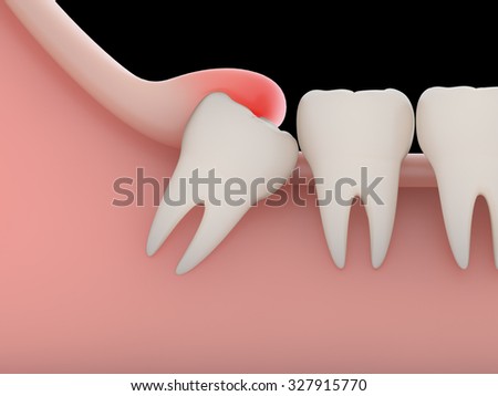 Problems caused by impacted wisdom teeth include.Infection(rendering)