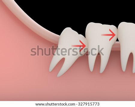 Problems caused by impacted wisdom teeth include.Crowding(rendering)