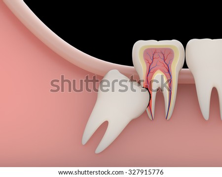 Problems caused by impacted wisdom teeth include.Erosion cavity(rendering)