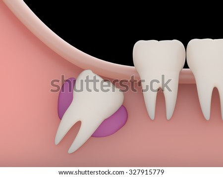 Problems caused by impacted wisdom teeth include.Cysts(rendering)