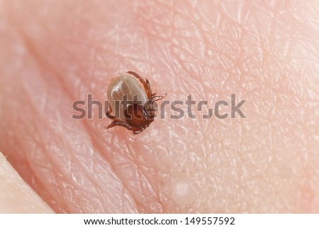 Castor bean Tick, Ixodes ricinus biting human, possible carrier of tick-borne encephalitis and lyme disease