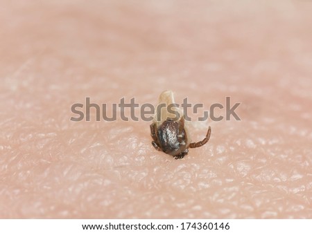 Tick bite, the tick is damaged after failed removal