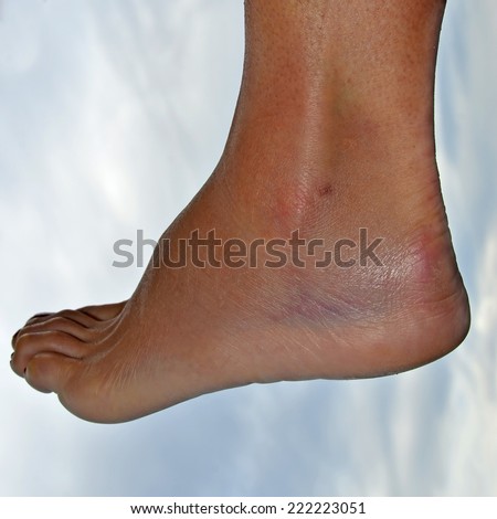 Swelling and bruising caused by a sprained ankle